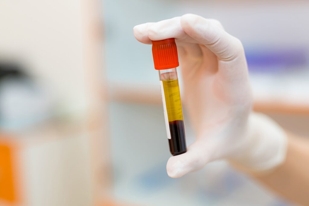 Tau, p-tau181, TDP-43, and α-Synuclein — Simultaneously, From 1 mL of Plasma
